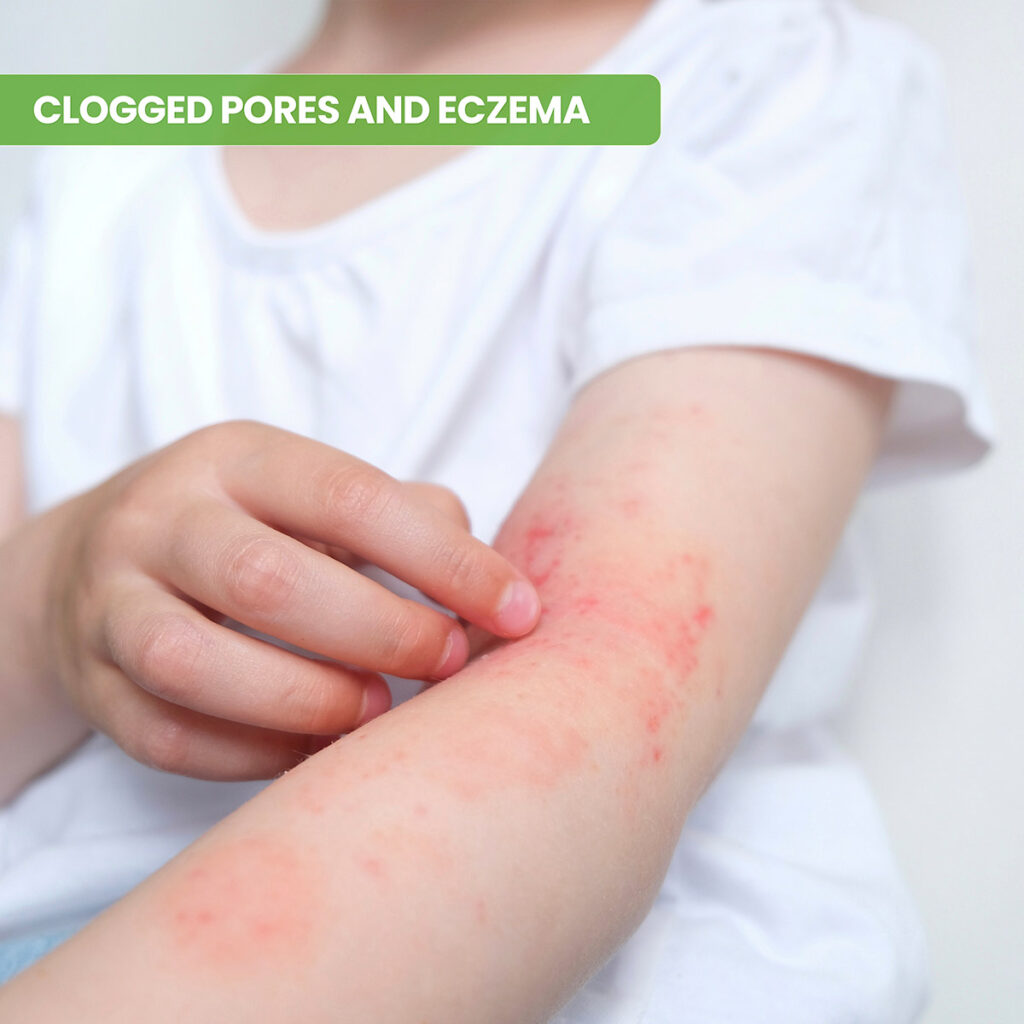 eczema